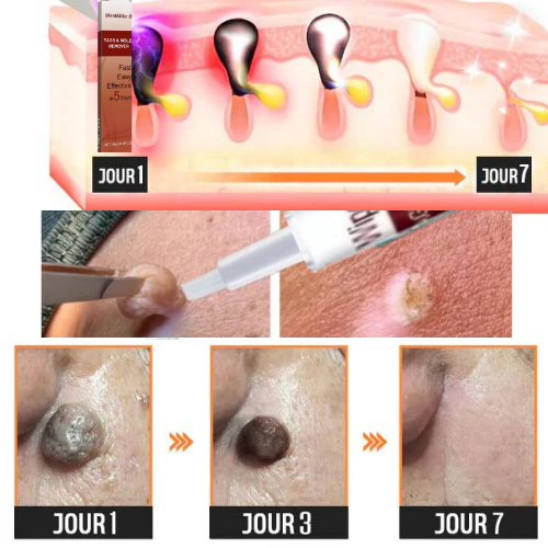 stylo pour enlever des acrochordons, taches et grains de beauté.
