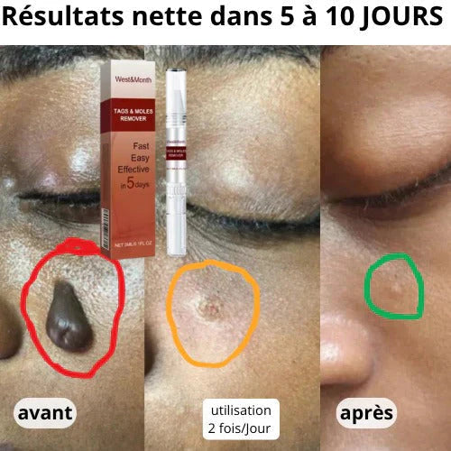 stylo pour enlever des acrochordons, taches et grains de beauté.